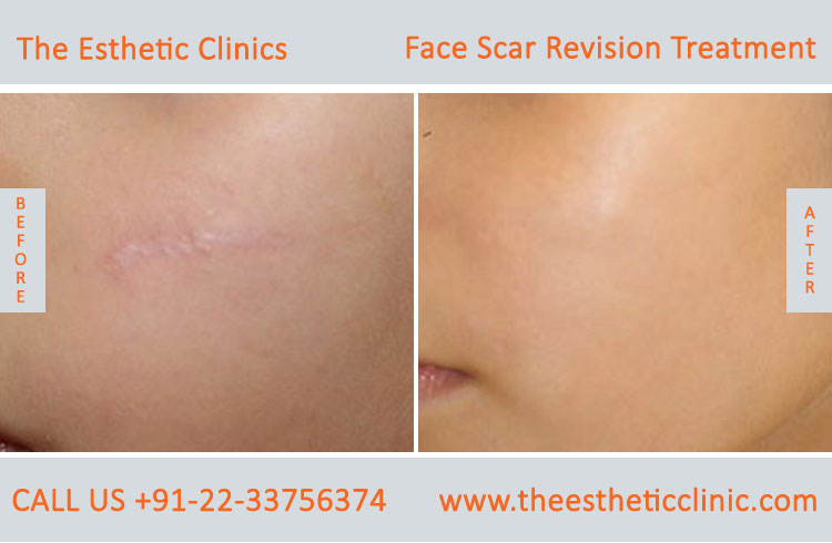 Facial Scars Revision laser Treatment for Face before after photos in mumbai india (1)